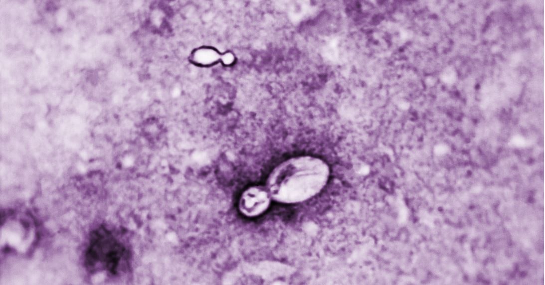 Histoplasmose.JPG